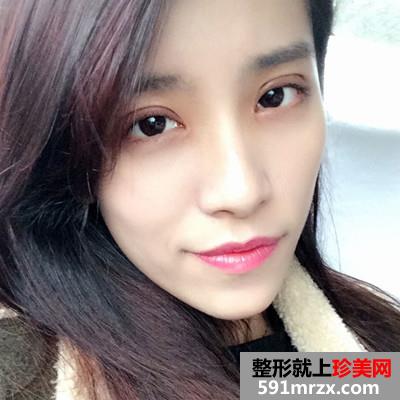 韩式全切双眼皮和开内眼角手术恢复过程分享附前后对比图