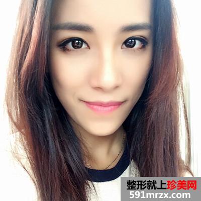 韩式全切双眼皮和开内眼角手术恢复过程分享附前后对比图
