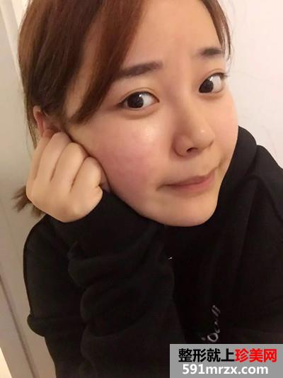 自体耳软骨垫鼻尖和硅胶假体隆鼻恢复过程记录附前后对比照