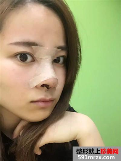 自体耳软骨垫鼻尖和硅胶假体隆鼻恢复过程记录附前后对比照