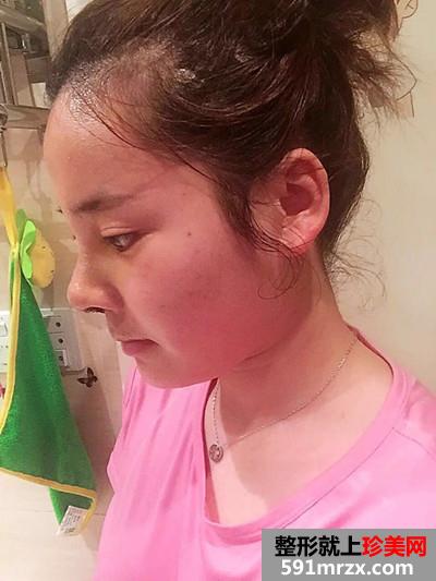 自体耳软骨垫鼻尖和硅胶假体隆鼻恢复过程记录附前后对比照