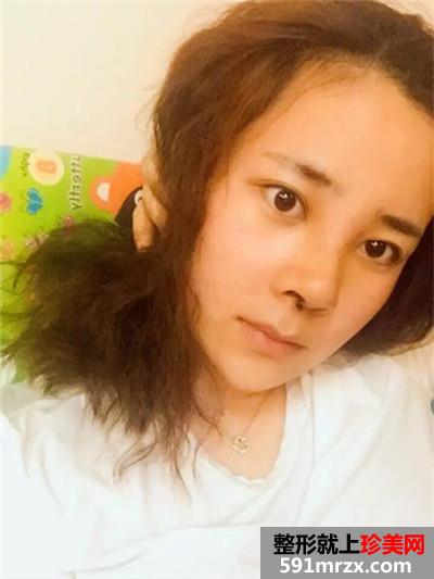 自体耳软骨垫鼻尖和硅胶假体隆鼻恢复过程记录附前后对比照