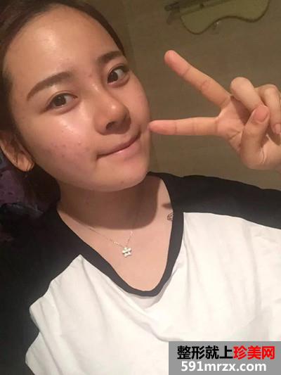 自体耳软骨垫鼻尖和硅胶假体隆鼻恢复过程记录附前后对比照