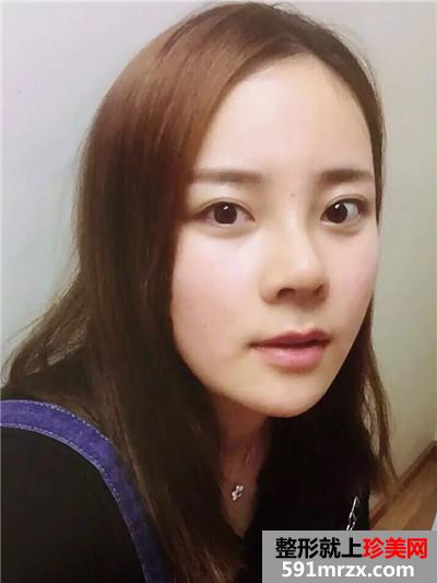 自体耳软骨垫鼻尖和硅胶假体隆鼻恢复过程记录附前后对比照