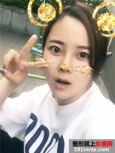 自体耳软骨垫鼻尖和硅胶假体隆鼻恢复过程记录附前后对比照