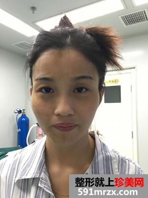 自体脂肪面部填充术后恢复过程和前后照片对比