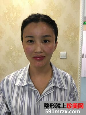 自体脂肪面部填充术后恢复过程和前后照片对比