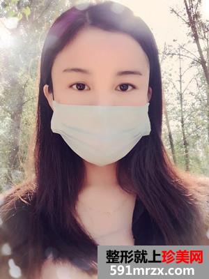 自体脂肪面部填充术后恢复过程和前后照片对比
