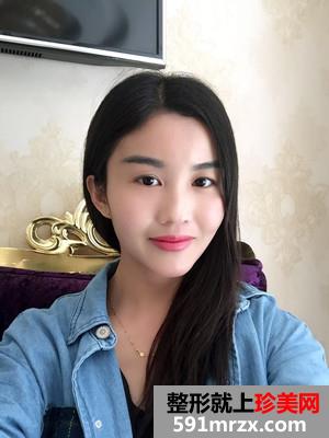 自体脂肪面部填充术后恢复过程和前后照片对比