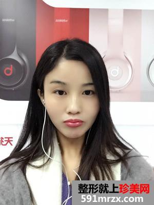 自体脂肪面部填充术后恢复过程和前后照片对比