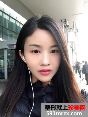 自体脂肪面部填充术后恢复过程和前后照片对比