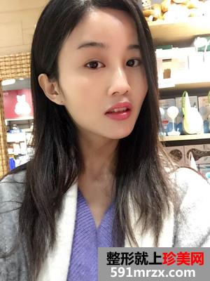 自体脂肪面部填充术后恢复过程和前后照片对比