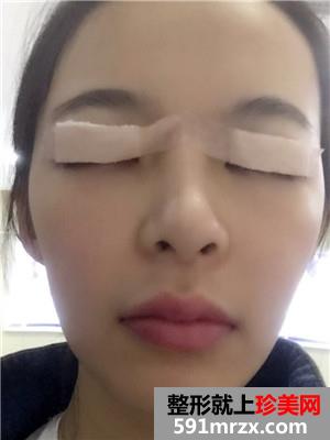 韩式三点双眼皮术后恢复过程和真实案例对比照