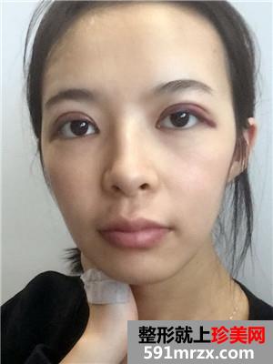 韩式三点双眼皮术后恢复过程和真实案例对比照