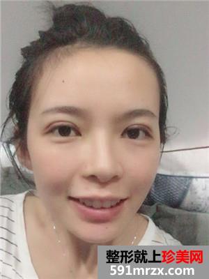韩式三点双眼皮术后恢复过程和真实案例对比照