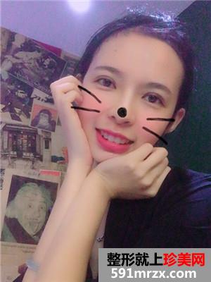 韩式三点双眼皮术后恢复过程和真实案例对比照