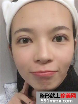 韩式三点双眼皮术后恢复过程和真实案例对比照