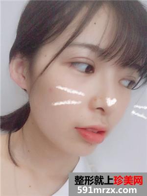 韩式三点双眼皮术后恢复过程和真实案例对比照