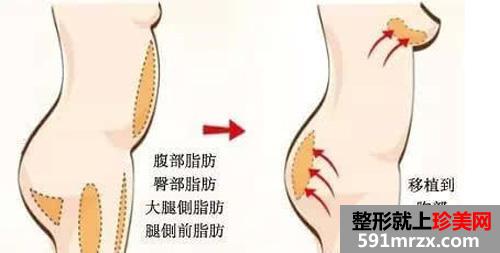 成都整形医院做自体脂肪丰臀一般需要多少钱
