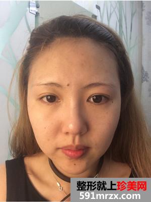 全脸像素激光+面颊去红血丝和点痣前后照片对比和恢复过程