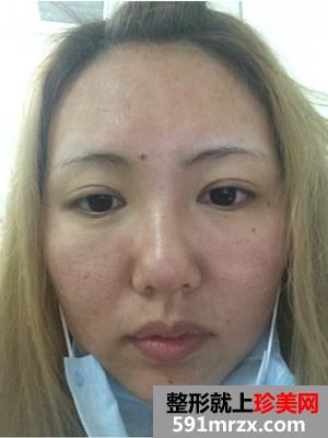 全脸像素激光+面颊去红血丝和点痣前后照片对比和恢复过程