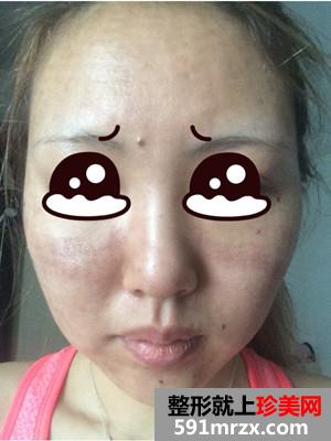 全脸像素激光+面颊去红血丝和点痣前后照片对比和恢复过程