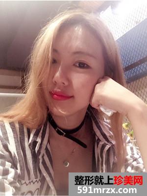 全脸像素激光+面颊去红血丝和点痣前后照片对比和恢复过程