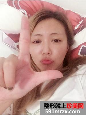 全脸像素激光+面颊去红血丝和点痣前后照片对比和恢复过程