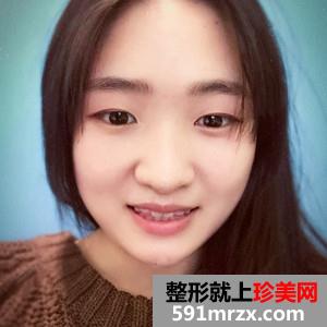 韩式三点双眼皮真实案例分享和恢复过程图片