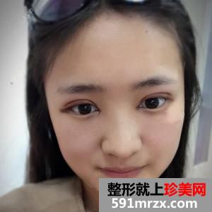 韩式三点双眼皮真实案例分享和恢复过程图片