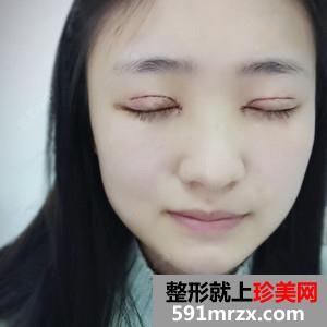 韩式三点双眼皮真实案例分享和恢复过程图片