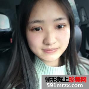 韩式三点双眼皮真实案例分享和恢复过程图片