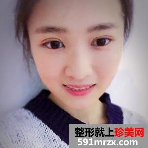 韩式三点双眼皮真实案例分享和恢复过程图片