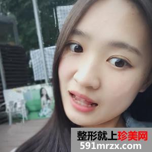 韩式三点双眼皮真实案例分享和恢复过程图片