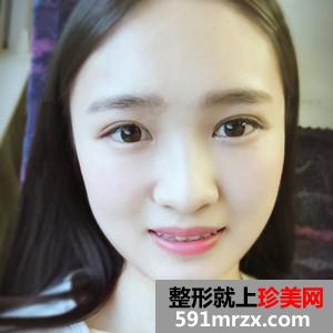 韩式三点双眼皮真实案例分享和恢复过程图片