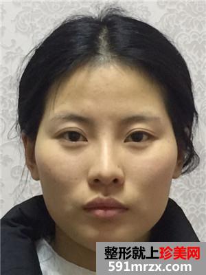 自体脂肪填充全脸加prp术后效果对比还有经验分享给大家