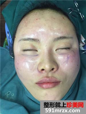 自体脂肪填充全脸加prp术后效果对比还有经验分享给大家