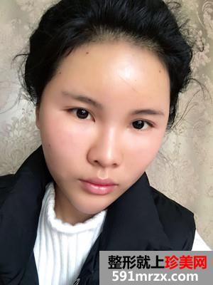 自体脂肪填充全脸加prp术后效果对比还有经验分享给大家
