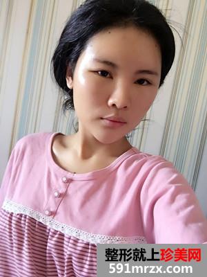 自体脂肪填充全脸加prp术后效果对比还有经验分享给大家