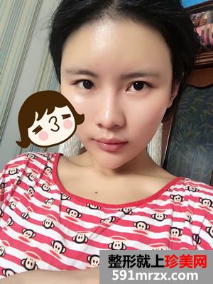 自体脂肪填充全脸加prp术后效果对比还有经验分享给大家