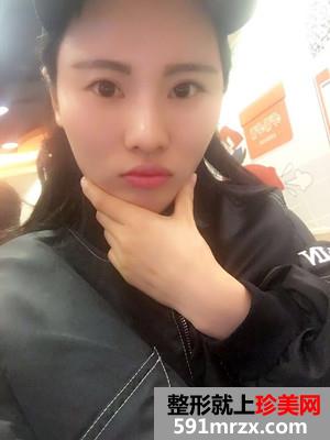 自体脂肪填充全脸加prp术后效果对比还有经验分享给大家