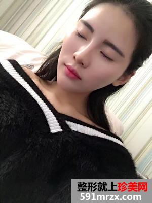 自体脂肪填充全脸加prp术后效果对比还有经验分享给大家
