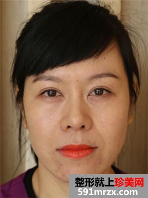 韩式面部埋线提升紧致恢复过程记录和对比照片分享