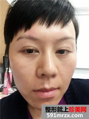 韩式面部埋线提升紧致恢复过程记录和对比照片分享