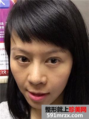韩式面部埋线提升紧致恢复过程记录和对比照片分享