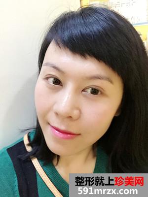 韩式面部埋线提升紧致恢复过程记录和对比照片分享