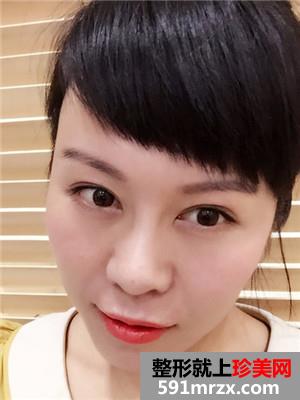 韩式面部埋线提升紧致恢复过程记录和对比照片分享