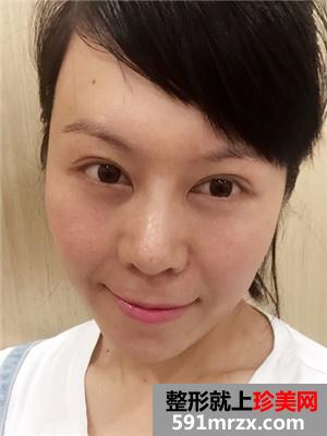 韩式面部埋线提升紧致恢复过程记录和对比照片分享