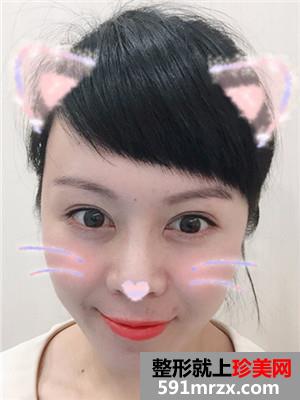 韩式面部埋线提升紧致恢复过程记录和对比照片分享