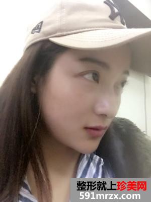 面部吸脂瘦脸术恢复过程和前后对比照分享